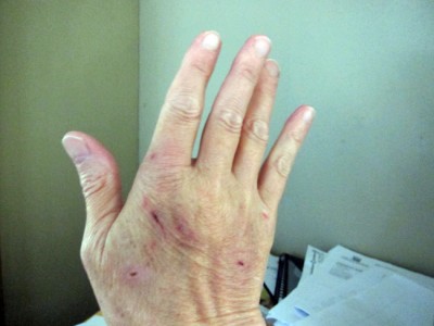 bruised hand, front view